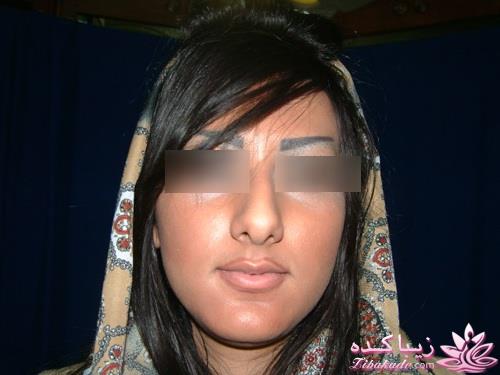 جراحی بینی - جراحی زیبایی